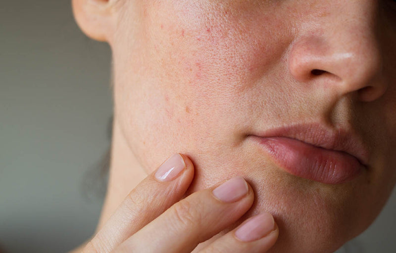 How To Get Rid Of Large Facial Pores